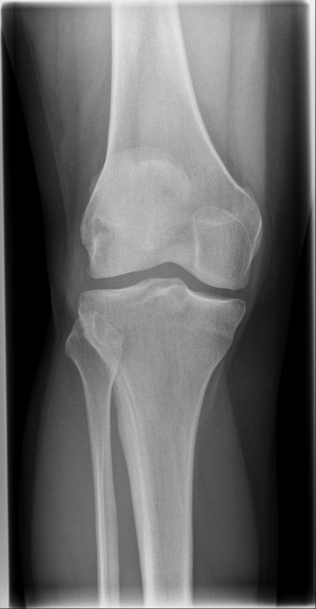 Localized intra-articular tenosynovial giant cell tumor - knee | Image ...