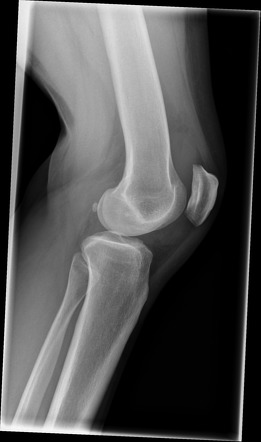 Localized intra-articular tenosynovial giant cell tumor - knee | Image ...