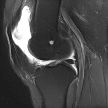 Localized intra-articular tenosynovial giant cell tumor - knee | Image ...