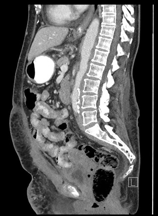 Follicular lymphomatosis | Image | Radiopaedia.org