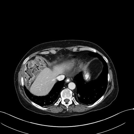 Chilaiditi syndrome | Radiology Case | Radiopaedia.org