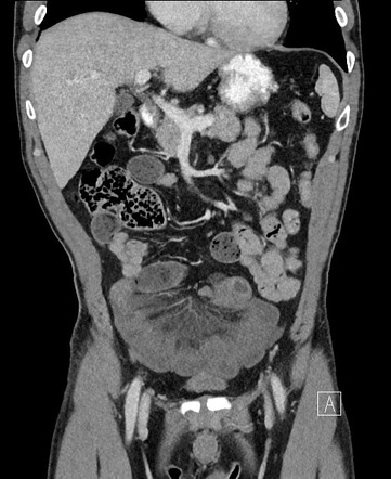 Closed loop obstruction | Radiology Reference Article | Radiopaedia.org