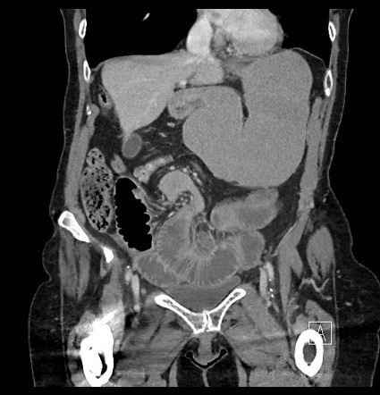 Intestinal volvulus | Radiology Reference Article | Radiopaedia.org