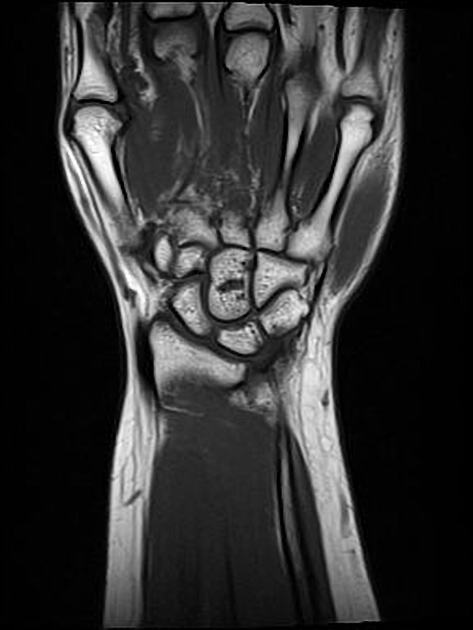 Extensor Carpi Ulnaris Subluxation Radiology Case Radiopaedia Org