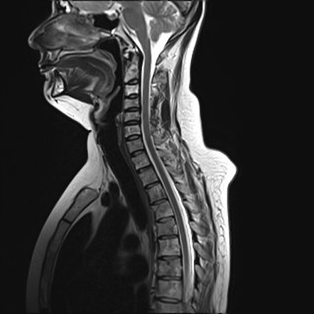 Secondary bone lymphoma | Image | Radiopaedia.org