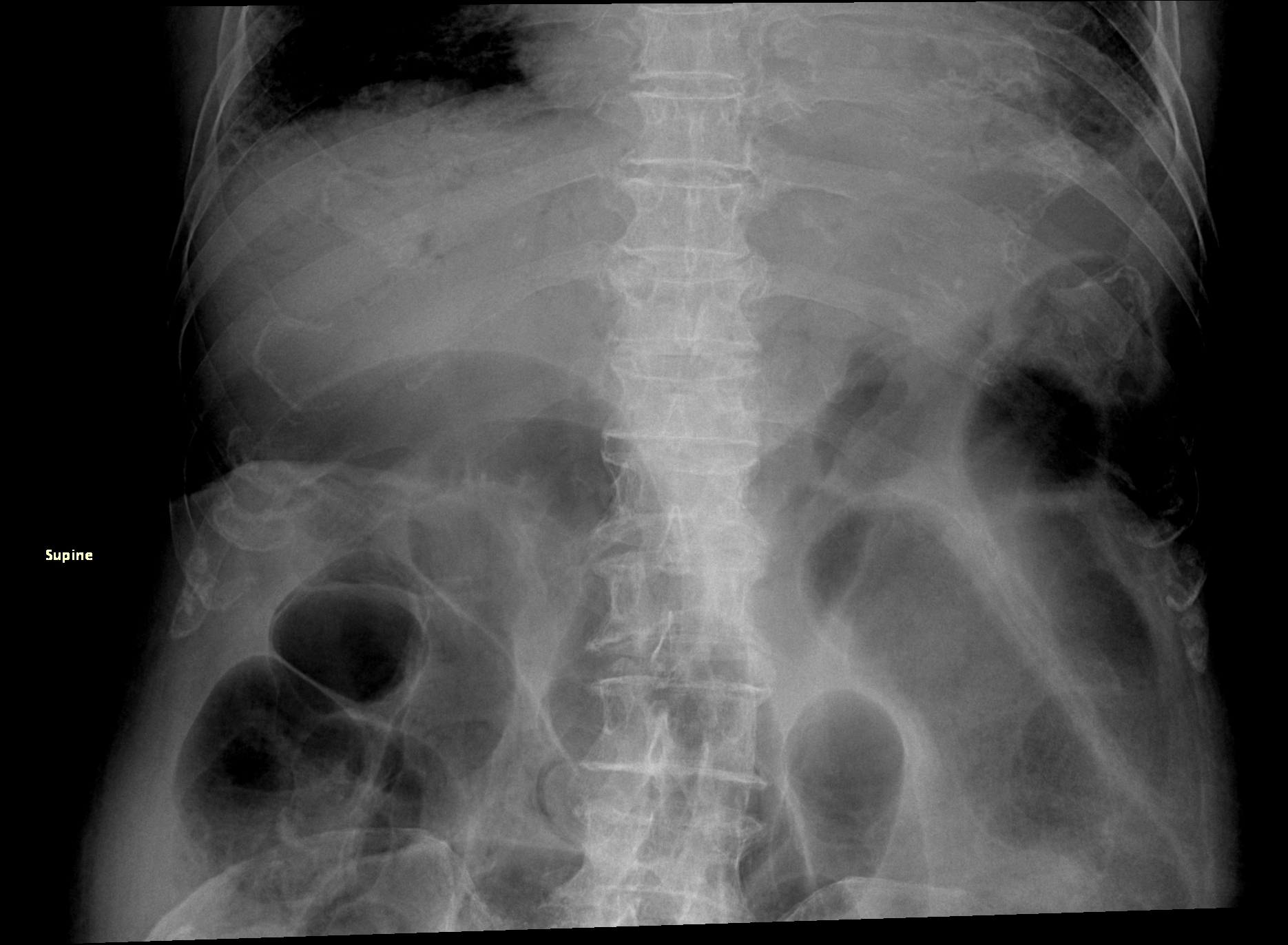 File:Mesenteric vascular occlusion, bowel infarction and portal venous ...