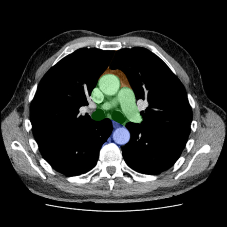 Mediastinal Mass Radiology Reference Article Radiopaedia Org