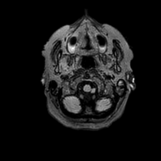 foramen magnum mri