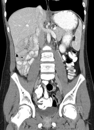 Intestinal Malrotation | Image | Radiopaedia.org