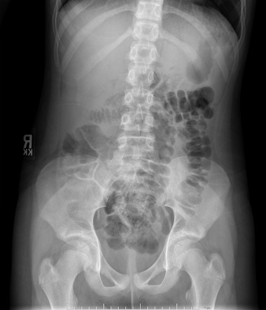 Intestinal Malrotation | Radiology Case | Radiopaedia.org