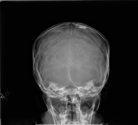 Convolutional markings | Radiology Case | Radiopaedia.org