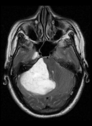 Giant cerebellopontine angle epidermoid cyst | Image | Radiopaedia.org