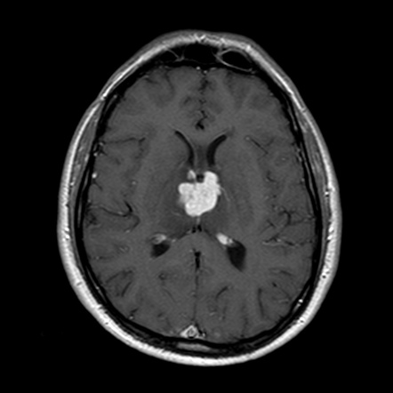 Primary CNS Lymphoma | Radiology Case | Radiopaedia.org