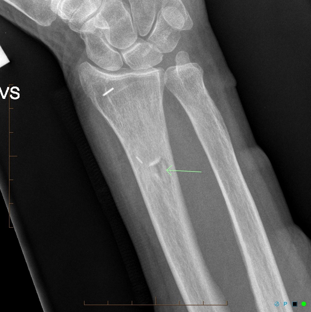 Dog bite fracture | Image | Radiopaedia.org