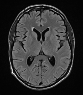 Ependymitis granularis | Image | Radiopaedia.org