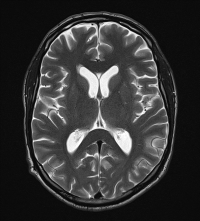 Ependymitis granularis | Image | Radiopaedia.org