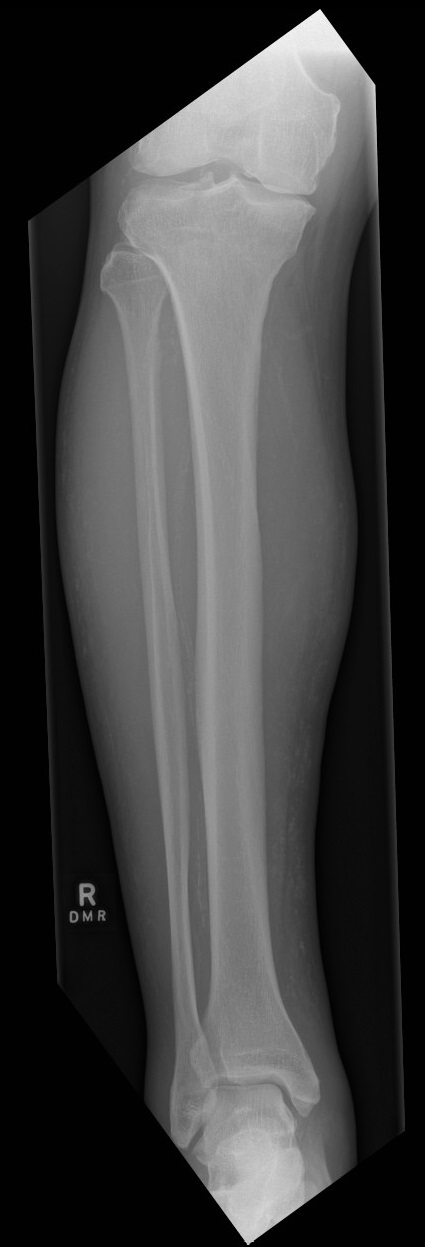 Leg calciphylaxis | Image | Radiopaedia.org