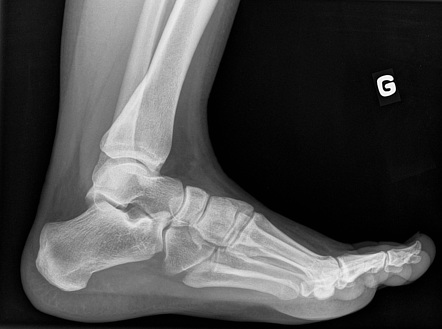 Osteoid osteoma of the distal tibia | Image | Radiopaedia.org