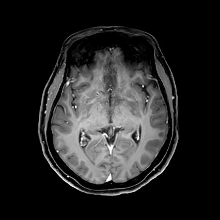 Hypothalamic germinoma | Image | Radiopaedia.org