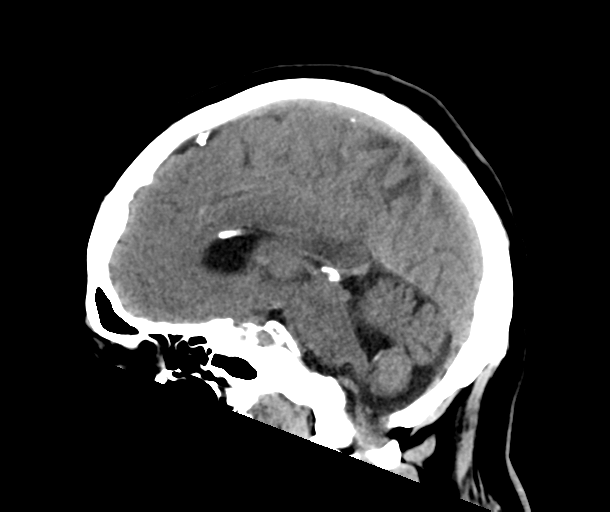 Intracranial perishunt fluid collection with edema | Image ...