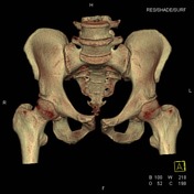 Open book pelvic injury, Radiology Reference Article