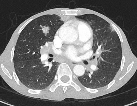 Pulmonary Kaposi sarcoma | Radiology Case | Radiopaedia.org