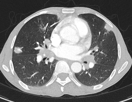 Kaposi Sarcoma Radiology Reference Article Radiopaedia Org