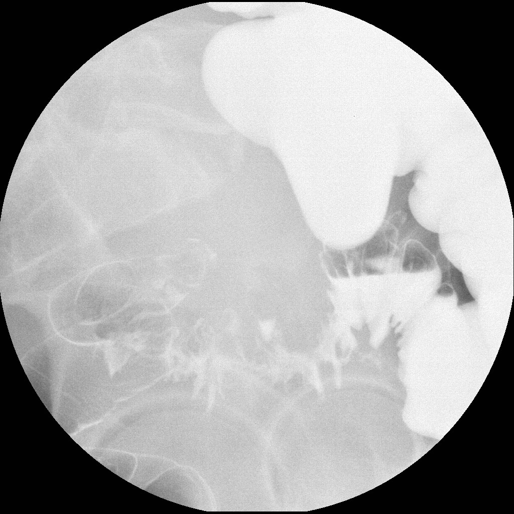 Diverticular stricture | Image | Radiopaedia.org