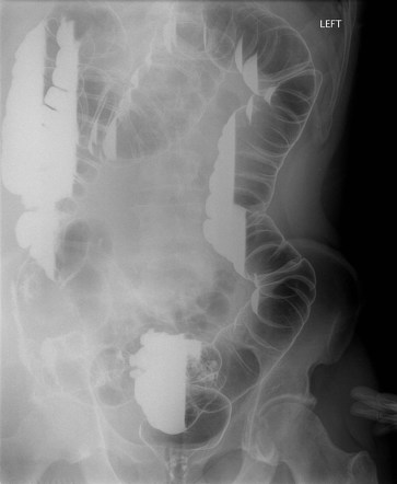 Diverticular stricture | Image | Radiopaedia.org