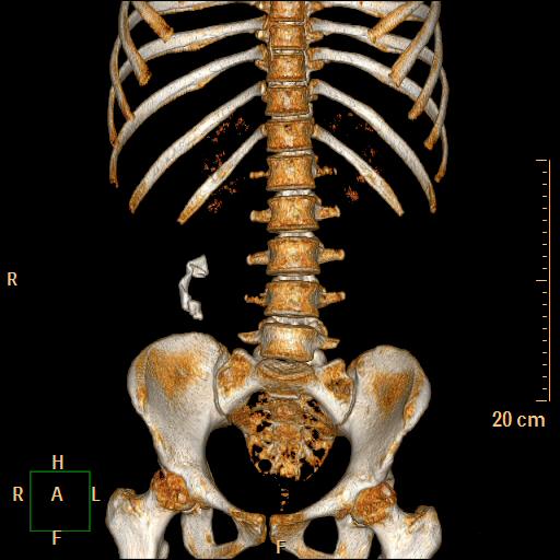 Gossypiboma | Image | Radiopaedia.org