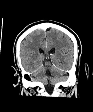 Dural sinus thrombosis secondary to otogenic infection | Image ...