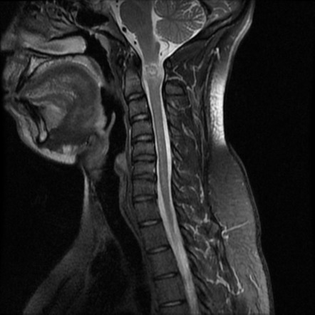 Cervical schwannoma | Image | Radiopaedia.org