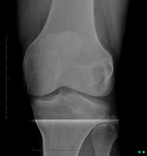 subchondral sclerosis