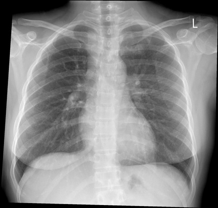 Tuberculosis (pulmonary manifestations) | Radiology Reference Article ...