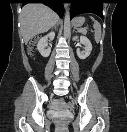 Playlist 'Uroradiology teaching pack' by Dr Ian Bickle