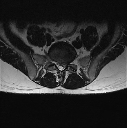 Extruded Disc With Nerve Impingement 