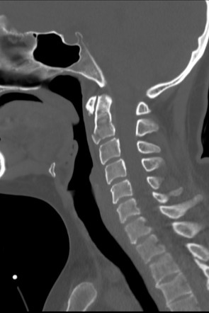 Extension teardrop fracture | Radiology Reference Article | Radiopaedia.org