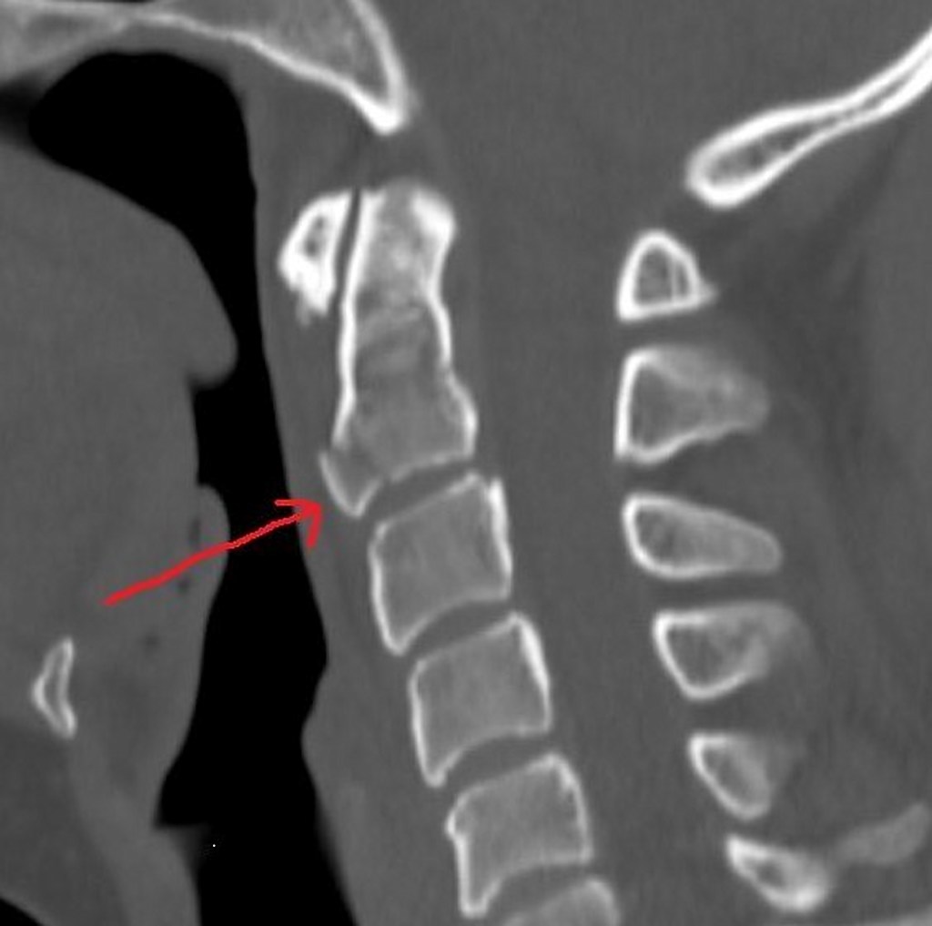 Extension Teardrop Fracture