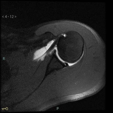 Kim lesion (shoulder) | Radiology Reference Article | Radiopaedia.org