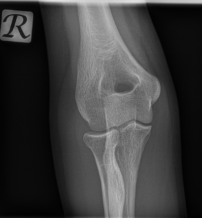 Radial head fracture | Radiology Case | Radiopaedia.org