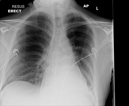 Left lower lobe collapse | Radiology Case | Radiopaedia.org