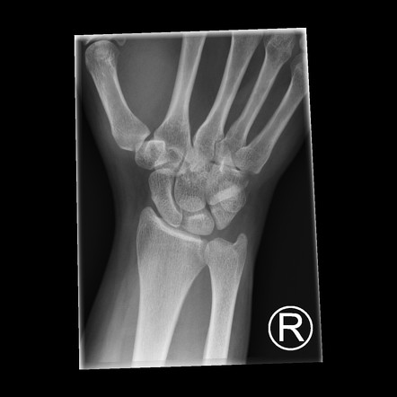 Thumb proximal phalanx avulsion fracture | Image | Radiopaedia.org