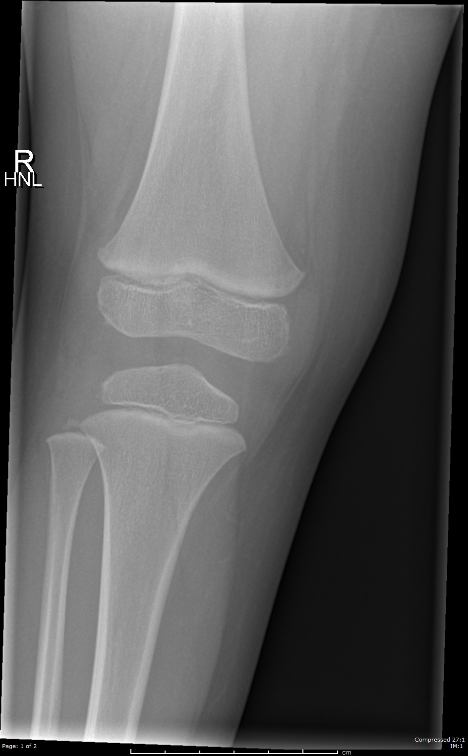 Normal knee x-ray - 4-year-old | Image | Radiopaedia.org