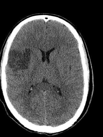 ICA (petrous) injury with its sequele | Image | Radiopaedia.org