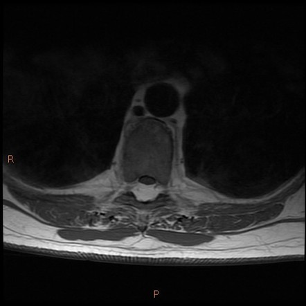 Spinal epidural lipomatosis | Image | Radiopaedia.org