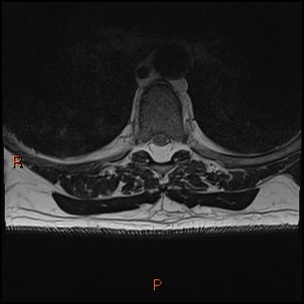 Spinal epidural lipomatosis | Radiology Case | Radiopaedia.org