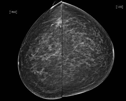 Wide local excision surgical clips | Image | Radiopaedia.org