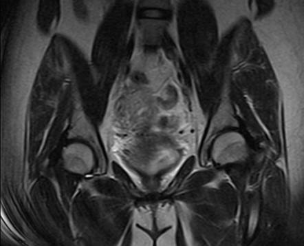 Tubal ectopic pregnancy (MRI) | Image | Radiopaedia.org