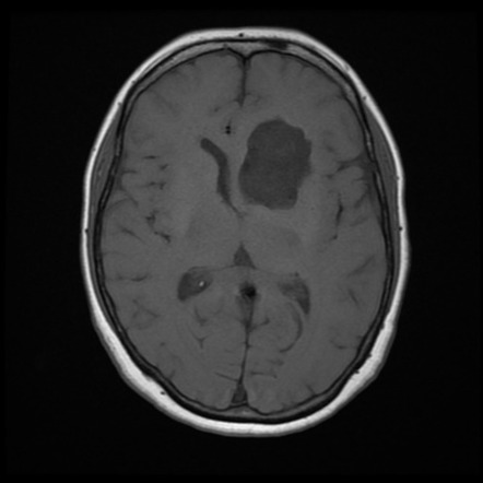 Epidermoid cyst: frontal and cerebellopontine angle | Image ...