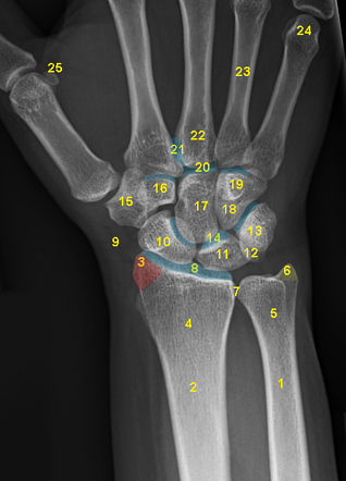 Wrist: annotated AP view | Radiology Case | Radiopaedia.org